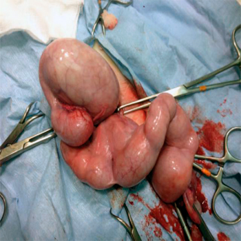 Hiperplasia endometrial quistica